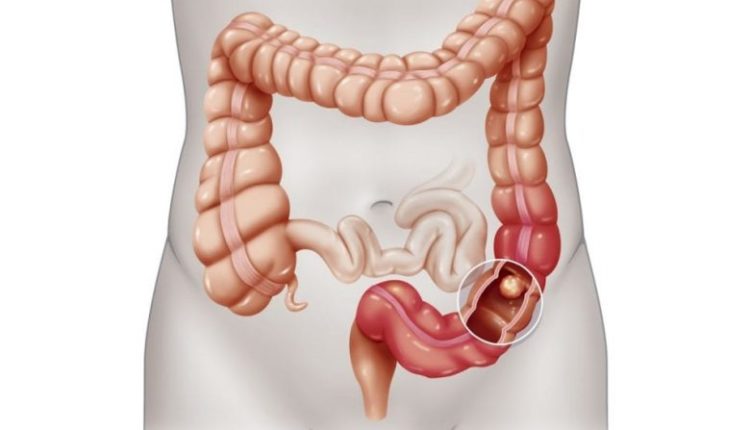 أعراض القولون العصبي الشائعة عند الإناث