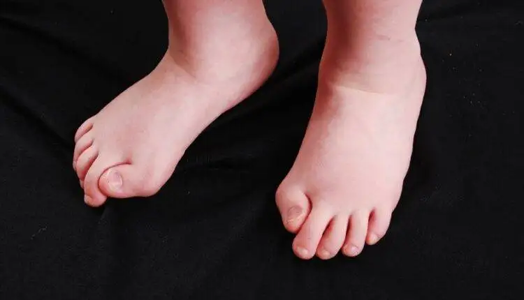 تشوهات أصابع القدم عند الأطفال