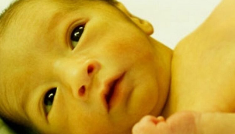 علاج اليرقان عند الأطفال حديثي الولادة
